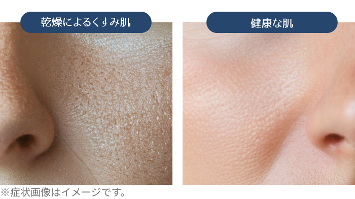 乾燥によるくすみ