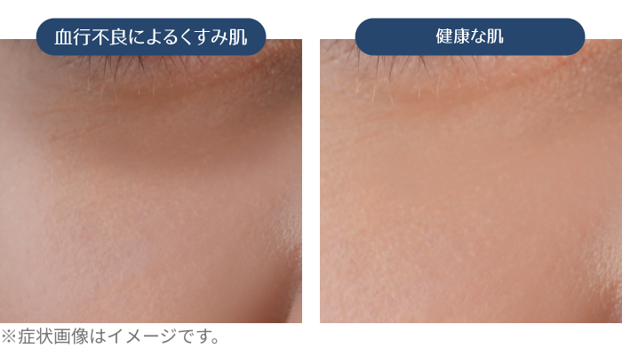 血行不良によるくすみ