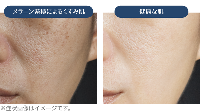 メラニン蓄積によるくすみ