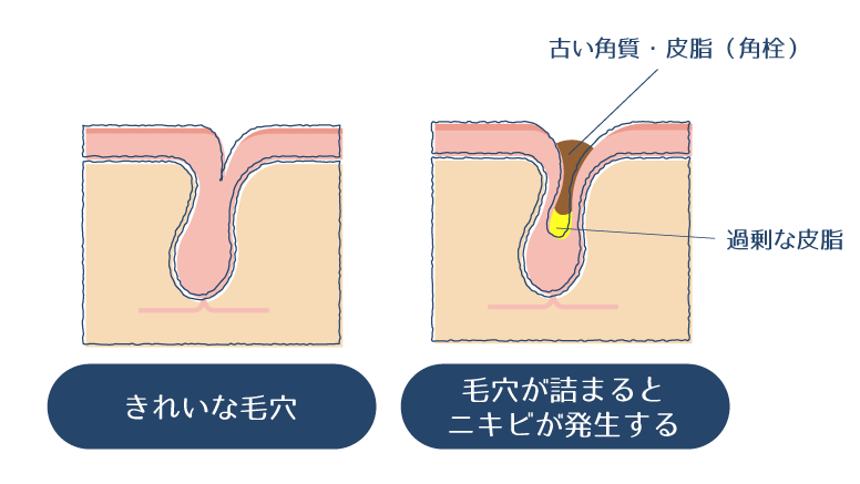 過剰な皮脂分泌により毛穴が詰まるとニキビができることを示した図