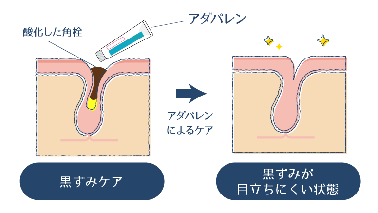 アダパレンゲルにより酸化した角栓をケアすることで、黒ずみが目立ちにくい状態になることを示した図。