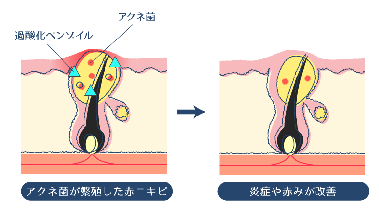 過酸化ベンゾイルにより、アクネ菌が繁殖した赤ニキビの炎症や赤みが改善されることを示した図。