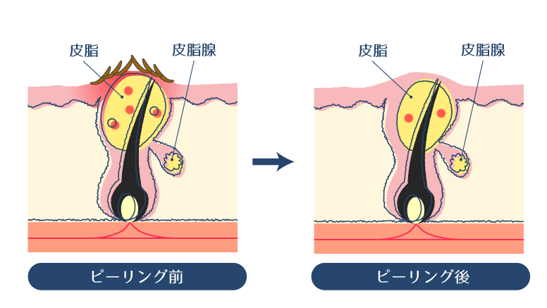 過酸化ベンゾイルのピーリング作用により、毛穴周辺の汚れや皮脂が解消されることで、黒ニキビや白ニキビが改善されることを示した図。