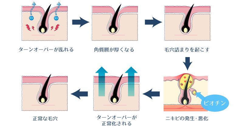 ビオチンが肌のターンオーバーを促進することで、ニキビが改善されることを示した図。