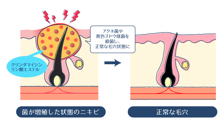 クリンダマイシンリン酸エステルが、炎症性ニキビ(赤ニキビ・黄ニキビ)の原因菌であるアクネ菌や黄色ブドウ球菌に対して殺菌効果を発揮し、その増殖を抑える過程を示した図。