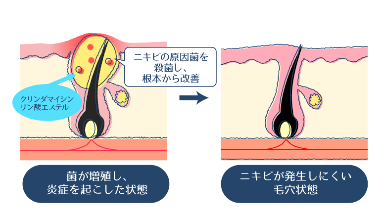 クリンダマイシンリン酸エステルがアクネ菌の増殖を抑制することで、炎症や膿を伴うニキビの悪化や再発のリスクを低減するメカニズムを示した図。