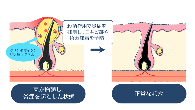 クリンダマイシンリン酸エステルが、ニキビの原因菌の増殖を抑制することで炎症を軽減し、結果としてニキビ跡や色素沈着の発生を予防するメカニズムを示した図
