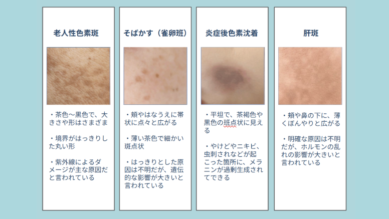 ハイドロキノンが効果を発揮するシミの種類である老人性色素斑・そばかす・炎症後色素沈着・肝斑の画像・特徴を示した図