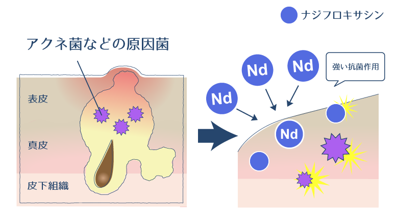 ナジフロキサシンが抗菌作用により、ニキビの原因となるアクネ菌やブドウ球菌を殺菌する過程を示した図。