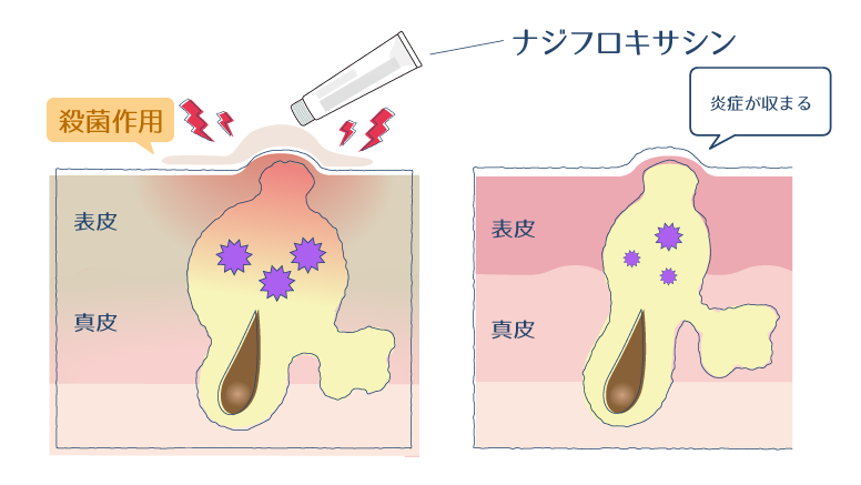 ナジフロキサシンの抗菌作用が細菌の増殖を抑制し、それによって炎症反応を穏やかにしていく過程を示した図