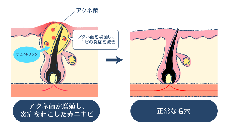 オゼノキサシンが、赤ニキビの炎症の原因菌であるアクネ菌に対し抗菌作用を発揮することで、ニキビの炎症を穏やかにする過程を示した図。