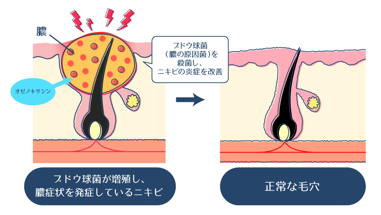 オゼノキサシンが殺菌作用で膿の原因菌であるブドウ球菌を殺菌することで、黄ニキビや紫ニキビの炎症や膿のケアをサポートする過程を示した図。