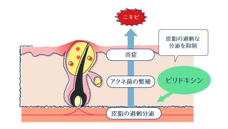 ピリドキシン塩酸塩が皮脂の過剰分泌を抑制することで、ニキビの発生を予防できることを示した図。