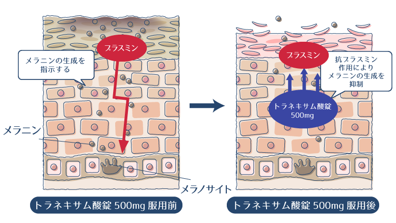 メラニンの生成を指示するプラスミンを、トラネキサム酸の抗プラスミン作用により抑制することで、シミ・肝斑が改善されることを示した図。