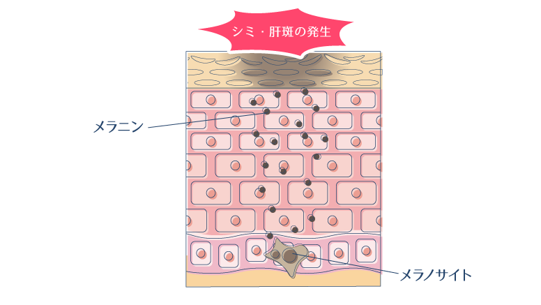 メラノサイトにより過剰生成されたメラニンが蓄積され、シミ・肝斑が発生する様子を示した図。