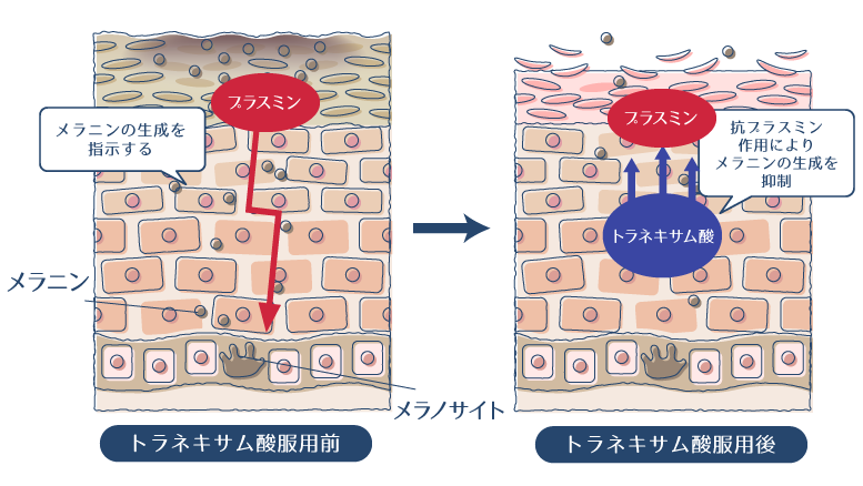 メラニンの生成を指示するプラスミンを、トラネキサム酸の抗プラスミン作用により抑制することで、シミ・肝斑が改善されることを示した図。
