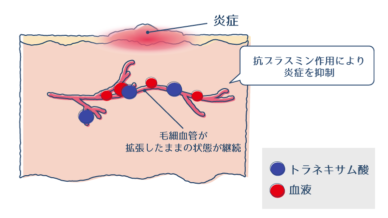 赤いニキビ跡(炎症後紅斑)の詳細