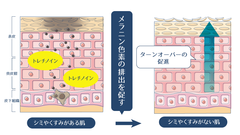 トレチノインの外用によりターンオーバーが促進され、メラニンが排出されることでシミ・くすみが改善されることを示した図。