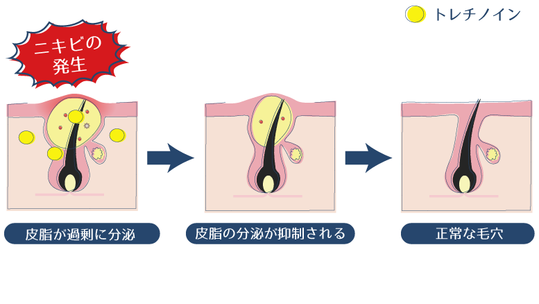 トレチノインの外用により、皮脂分泌が抑制され、ニキビが改善されることを示した図。