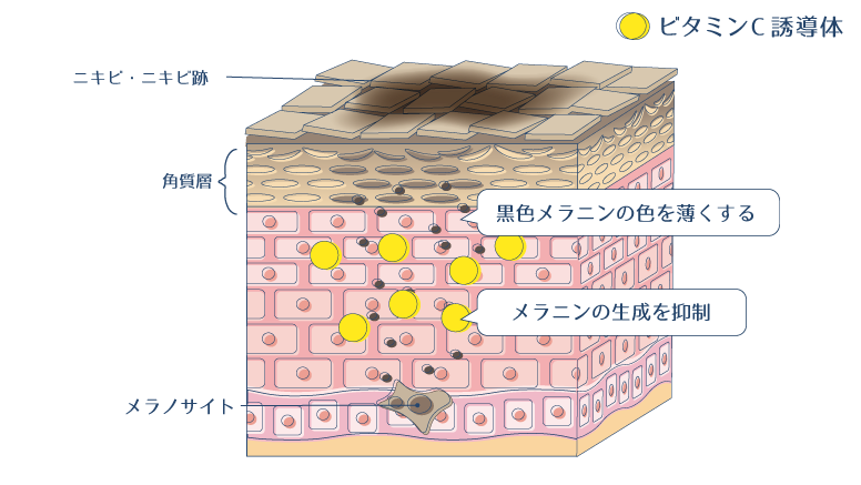 ビタミンC誘導体がチロシナーゼの働きを抑制し、メラニン生成を防ぐとともに、黒色メラニンを還元することでシミ・ニキビ跡を改善する過程を示した図
