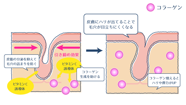 ビタミンC誘導体が皮脂分泌を抑制し、コラーゲン生成を促進することで毛穴を引き締める過程を示した図。