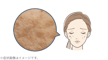 老人性色素斑(日光性のシミ)