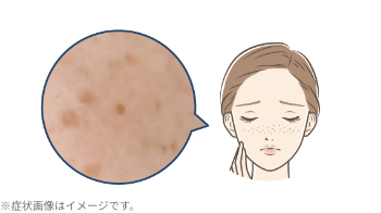そばかす(雀卵斑)
