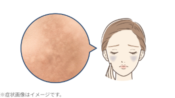肝斑