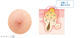 黄ニキビ (化膿)の詳細