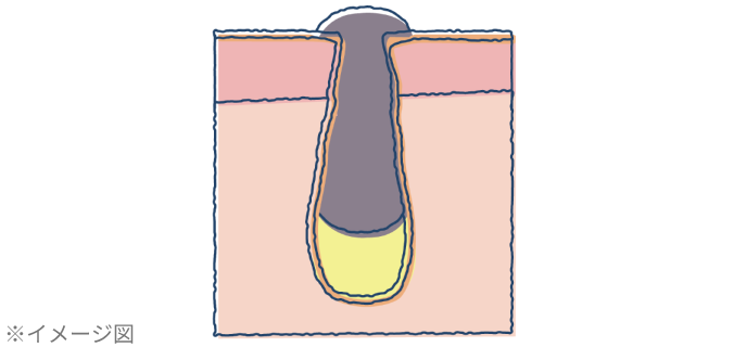 つまり毛穴 (黒ずみ毛穴)の詳細