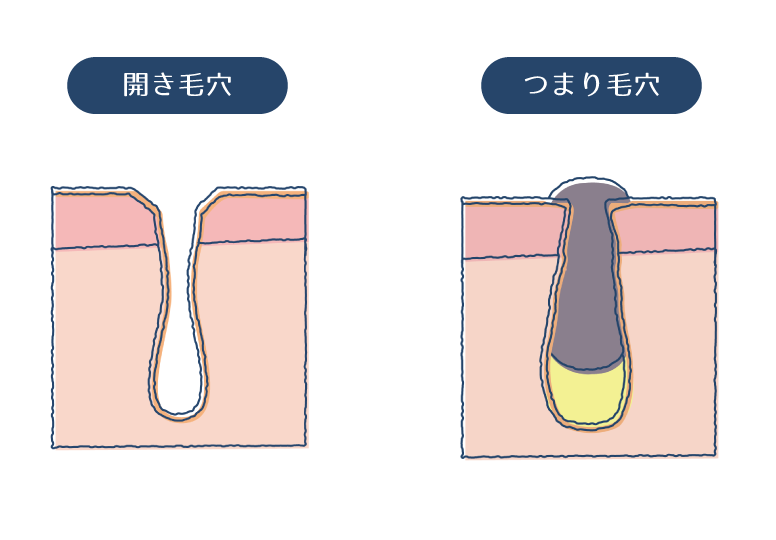 毛穴トラブルの種類 (開き・黒ずみ・たるみなど) - Before