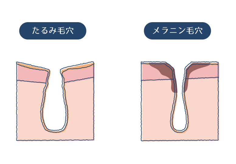 毛穴トラブルの種類 (開き・黒ずみ・たるみなど) - After