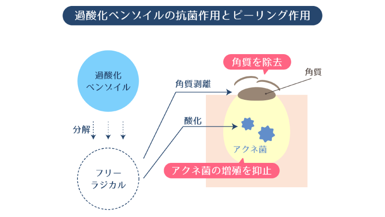 過酸化ベンゾイルの持つ抗菌作用やピーリング作用によって、毛穴の角栓を除去し、アクネ菌の増殖を抑止する様子を示す図。