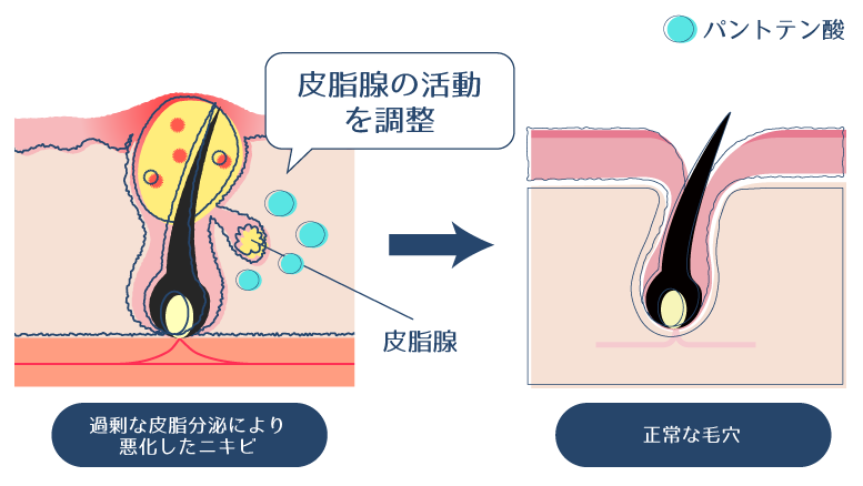 パントテン酸Caが皮脂腺の活動を調整し、過剰な皮脂分泌によるニキビの改善を示す図。