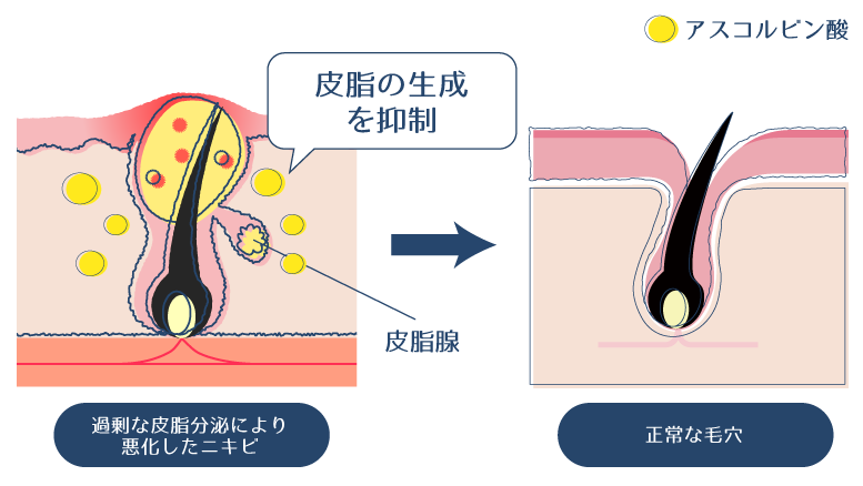 アスコルビン酸が皮脂の生成を抑制するように働きかけ、過剰な皮脂分泌によるニキビの改善を示す図。