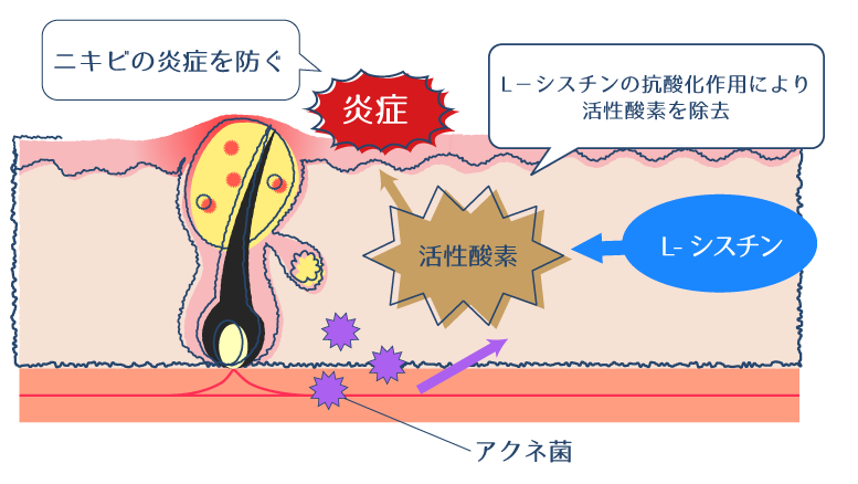 L-シスチンの抗酸化作用が活性酸素を除去するように働きかけ、ニキビの炎症を防ぐことを示す図。