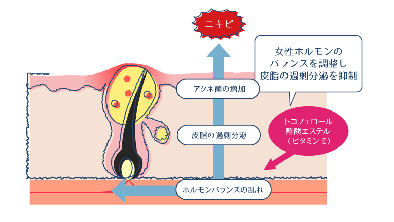 ホルモンバランスの乱れが原因でニキビができるまでの過程に対して、トコフェロール酢酸エステルのニキビ予防の働きを示す図。