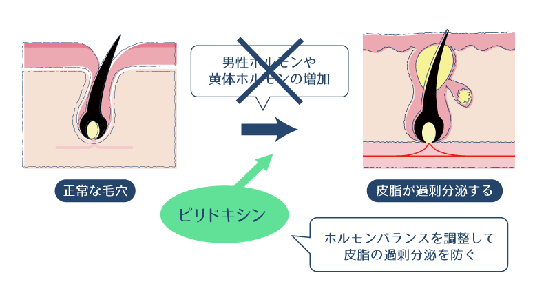 ピリドキシンが、ホルモンバランスを調整し、皮脂の過剰分泌を防ぐことで、ニキビを予防・改善することを示した図。