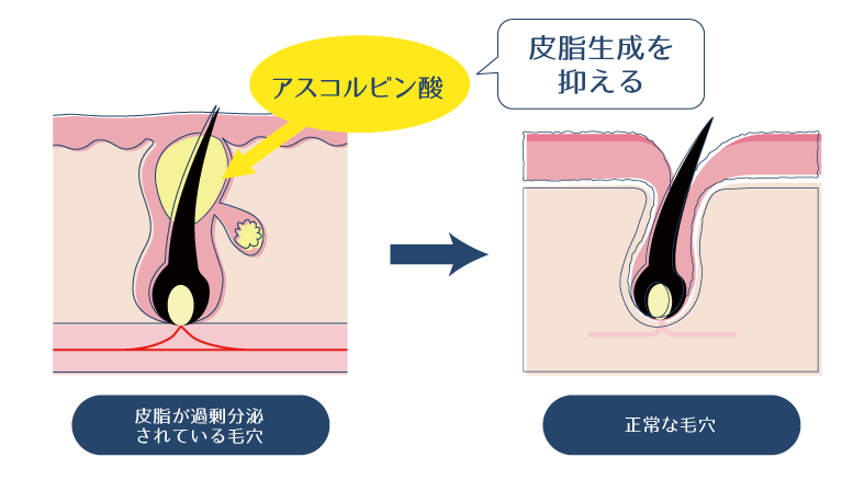 アスコルビン酸が、皮脂が過剰分泌されている毛穴に対して、皮脂生成を抑えるよう働きかけることで、ニキビを改善することを示した図。
