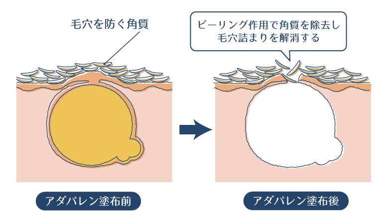 アダパレンのピーリング作用により、角質を除去し毛穴詰まりを解消することで、ニキビを予防・改善することを示した図。