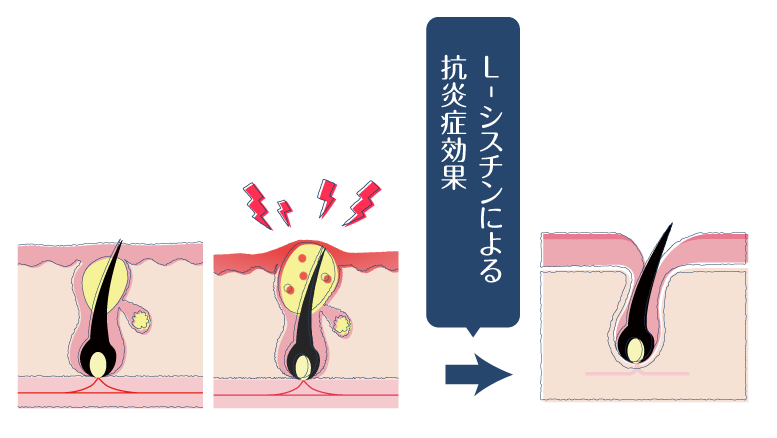 L-シスチンの抗炎症作用により、ニキビの炎症を抑えることができることを示した図。