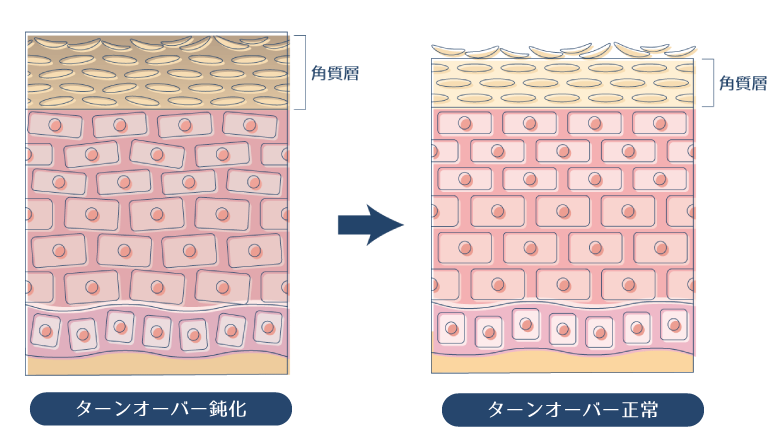 肌のターンオーバーが鈍化すると古い角質が留まり、肌がくすむが、肌のターンオーバーを正常にすると、古い角質が排出され、肌の調子が整うことを示した図。