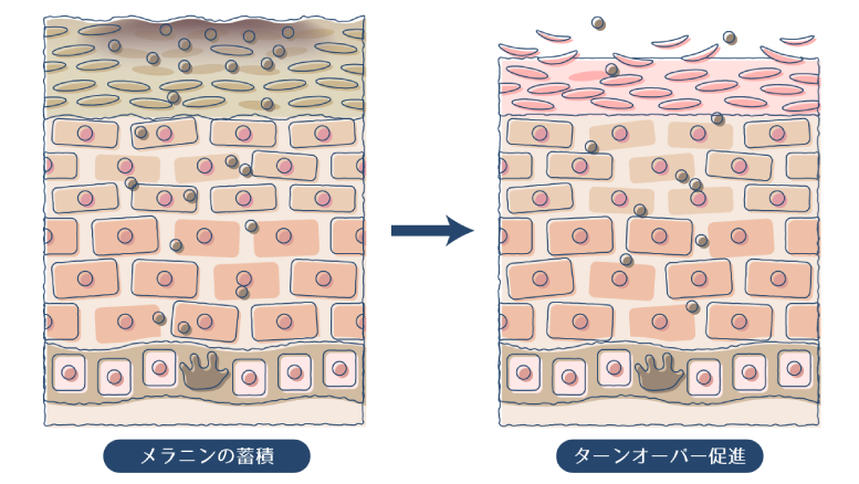 メラニンの蓄積によりシミが発生するので、ターンオーバーを促進し、メラニンを排出することで、シミを改善できることを示した図。