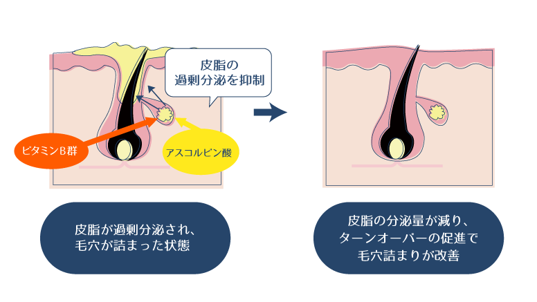 アスコルビン酸・ビタミンB群が皮脂の過剰分泌を抑制することで、皮脂の分泌量が減り、毛穴詰まりが改善できることを示した図。
