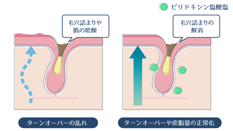 ピリドキシン塩酸塩が、肌のターンオーバーや皮脂量を正常化することで、毛穴詰まりや肌の乾燥を改善することを示した図。