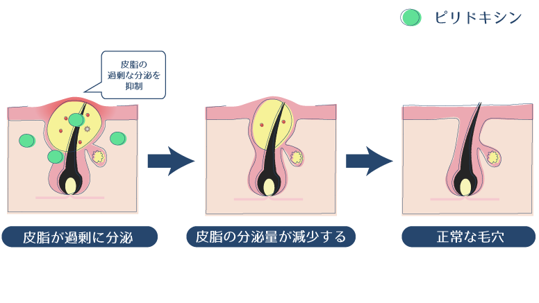 ピリドキシンが皮脂の過剰分泌を抑制することで、ニキビや肌荒れを防ぐ図