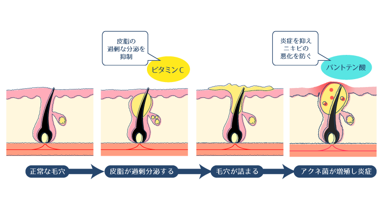 アスコルビン酸が皮脂の過剰分泌を抑制し、パントテン酸が炎症を抑えることで、ニキビを改善する図