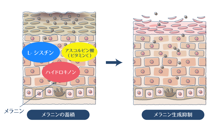 L-シスチン・アスコルビン酸・ハイドロキノンがメラニンの生成を抑制することで、シミが改善されることを示した図。