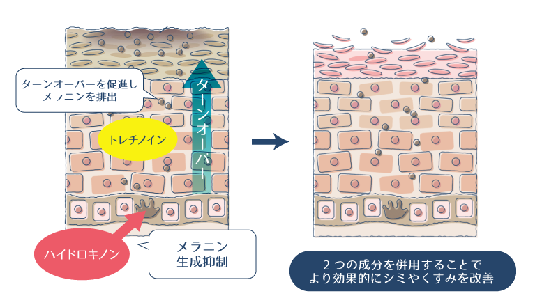 ハイドロキノンがメラニンの生成を抑制し、その間にトレチノインがターンオーバーを促進し、メラニンを排出することで、シミやくすみが改善されることを示した図。