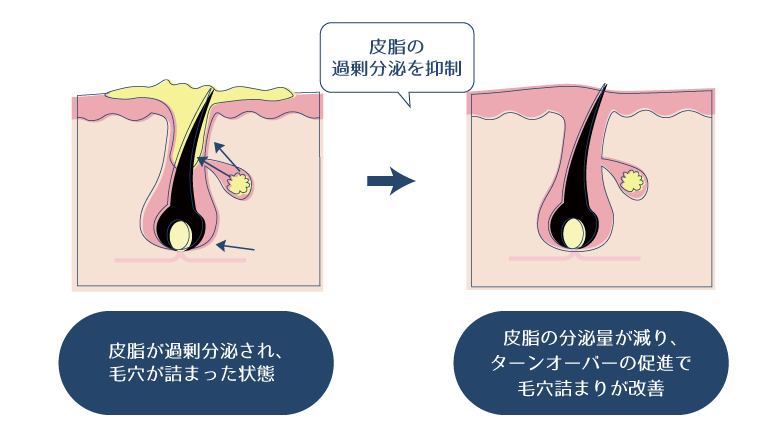 ビタミンC誘導体が皮脂腺に働きかけて皮脂量を調整することで、皮脂のバランスが整い、毛穴詰まりが解消する様子を示す図。